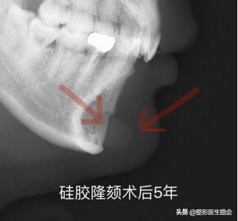 鐗欓娇澶栧嚫涓嬪反鍚庣缉鎬庝箞鐭,涓颁笅宸村彲浠ユ敼鍠勭墮榻垮悗缂╁悧