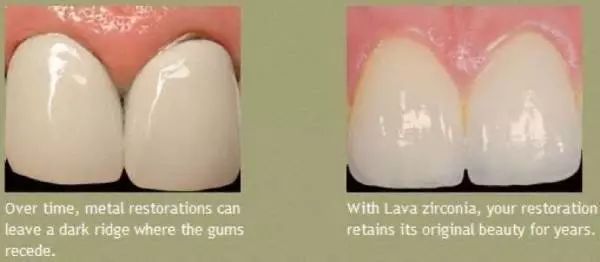 烤瓷牙做什么样的性价比高,沈阳烤瓷牙哪家便宜又好