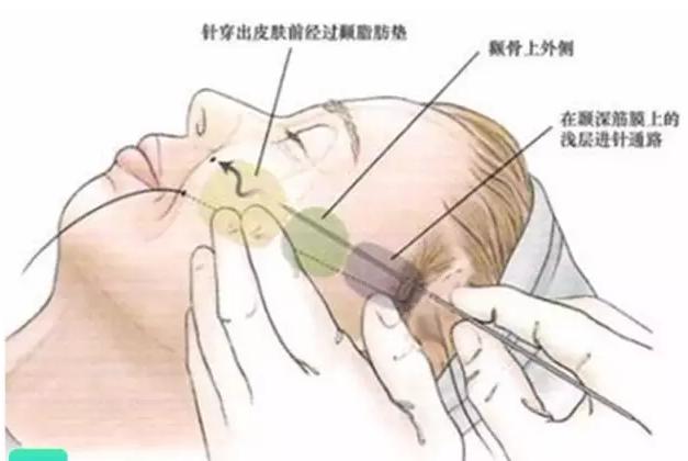 科普|光子嫩肤全攻略,做了光子后禁忌事项有哪些?