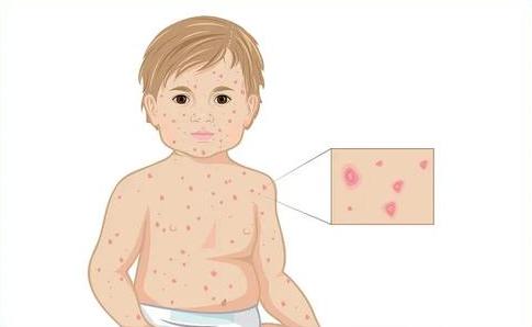 哪些人容易得令人痛苦不堪的“带状疱疹”？