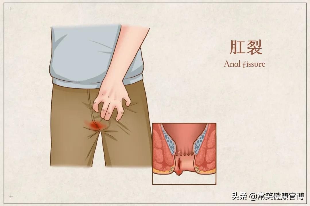 肛裂的原因是怎么引起的,肛裂是什么原因引起的怎么治疗