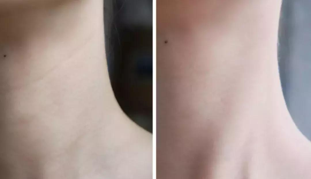 哪些护肤成分用了会脸黑,这些护肤行为可能会烂脸