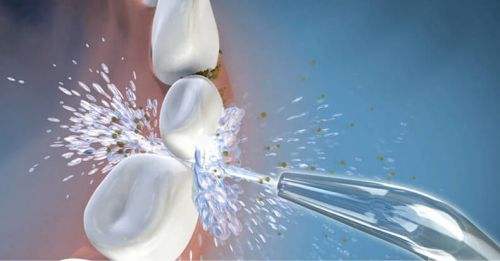 洗牙多长时间洗一回,洗牙多长时间洗一次牙垢