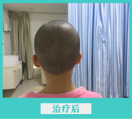 儿童初发白斑的治愈率,白斑早期有啥征兆