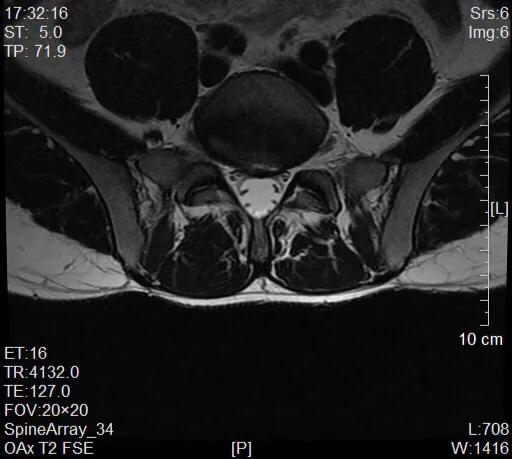 痔疮外痔形成原因,痔疮的形成和治疗