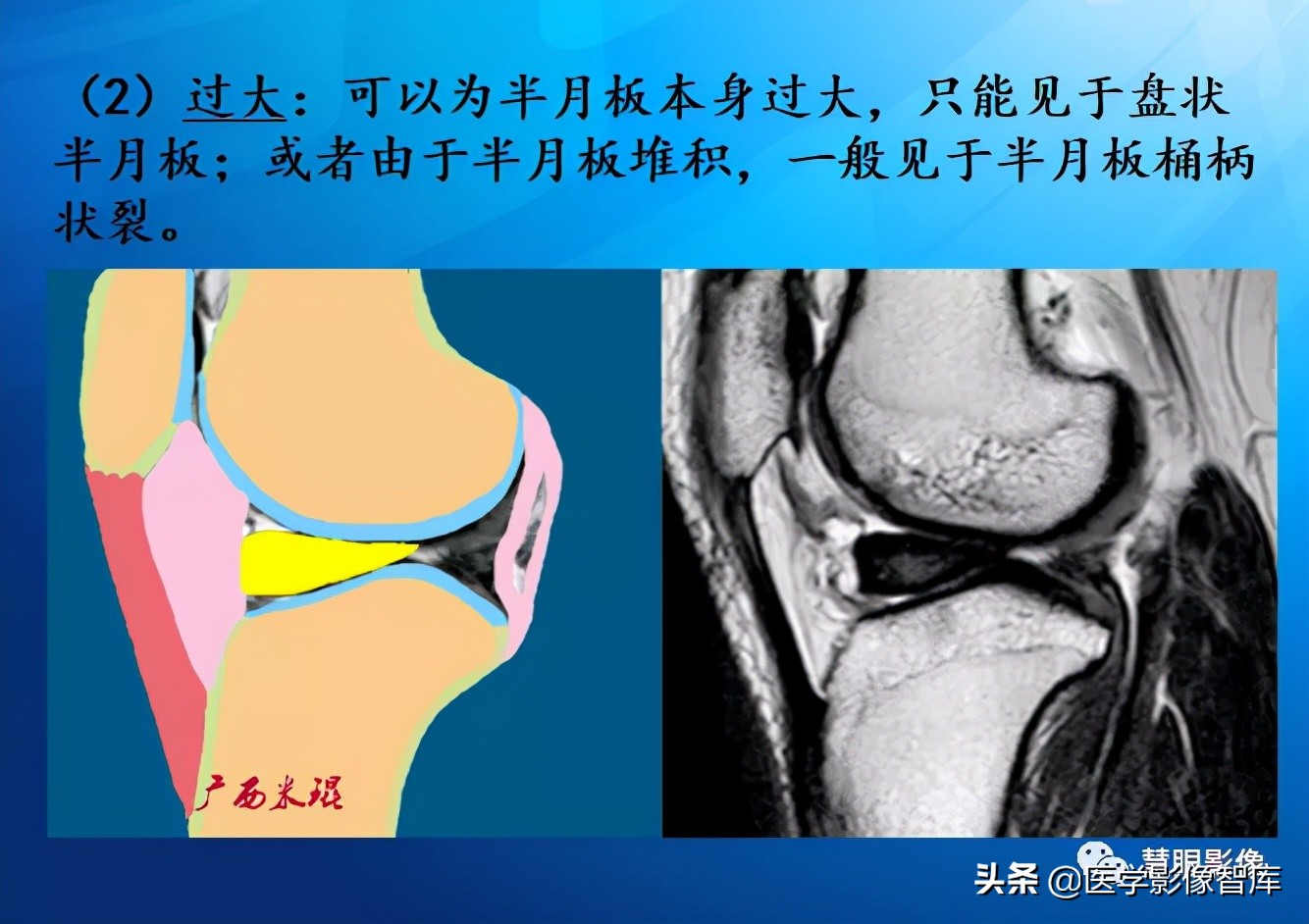 膝关节半月板损伤的解剖结构图,半月板mri解剖图解