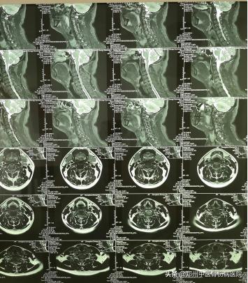 李氏砭法刮痧直播,李氏虎符铜砭刮痧治腰椎间盘突出