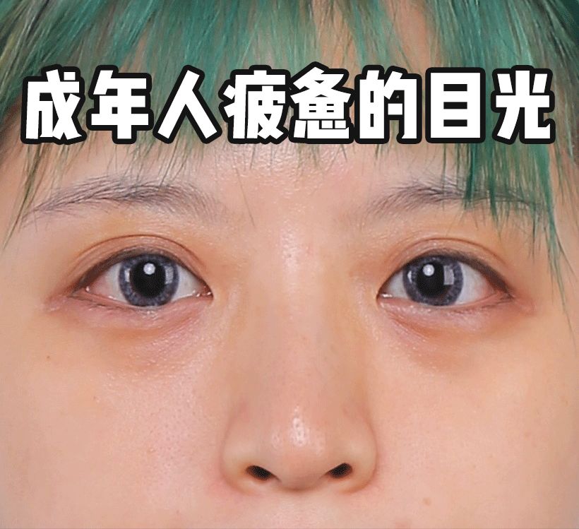 董氏奇穴一针治疗黑眼圈,熊猫针一针就能去掉黑眼圈吗