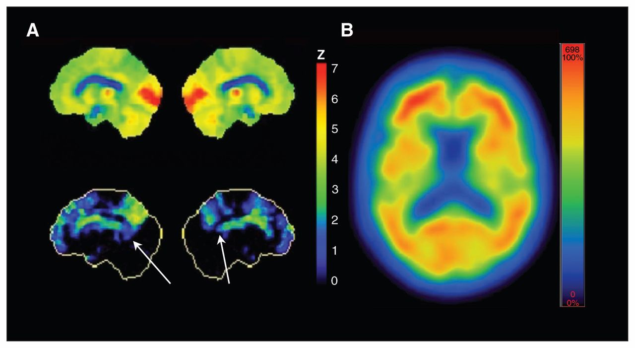 爱因斯坦大脑和平常人大脑对比,爱因斯坦如何开发大脑