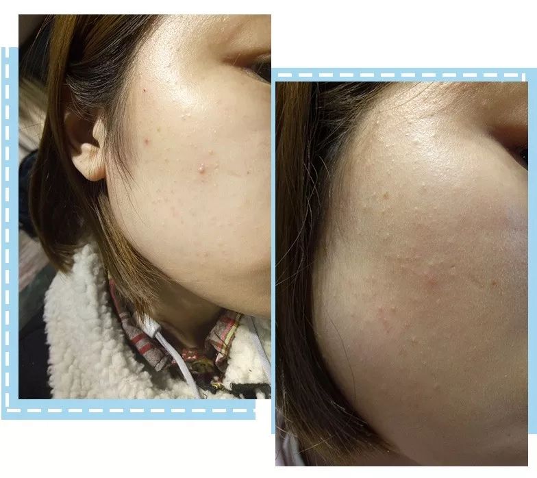 教你一招搞定痘痘告别烦人痘印,教你一招痘痘全消掉