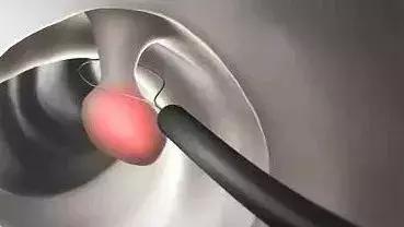 结节息肉囊肿增生哪个是癌症先兆,乙状结肠增生性的息肉会癌变吗