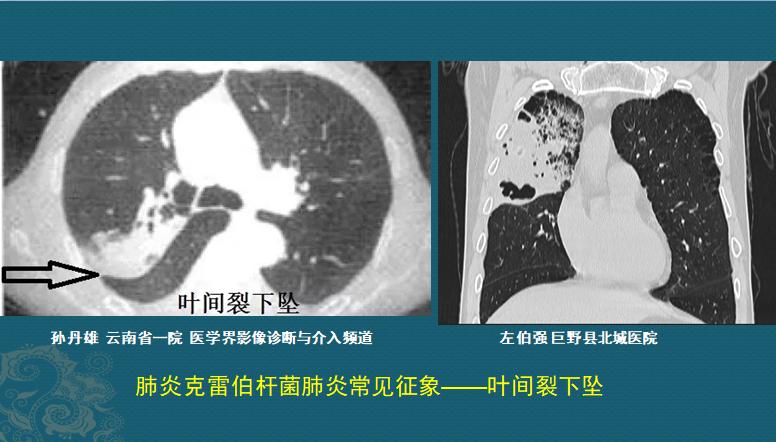 肺炎感染者吐痰,肺炎患者咳大量黄痰最有可能感染