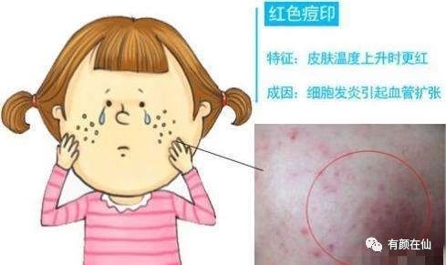 如何消除红色痘印,后背红色痘印怎么消除
