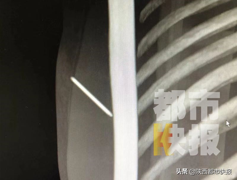 缝衣针扎到手要打破伤风吗,缝衣针戳到手肿了