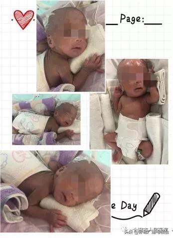 600克袖珍婴儿出院,860克早产女婴