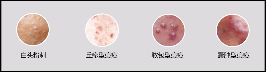 营养学调理痘痘,痘痘肌上火应该吃什么