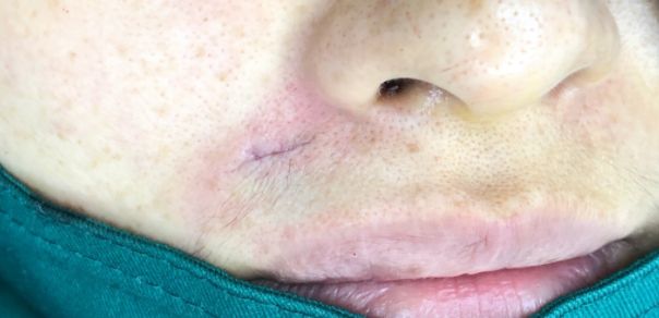 起痣是用药好还是用激光好,点长毛的痣需要手术还是激光