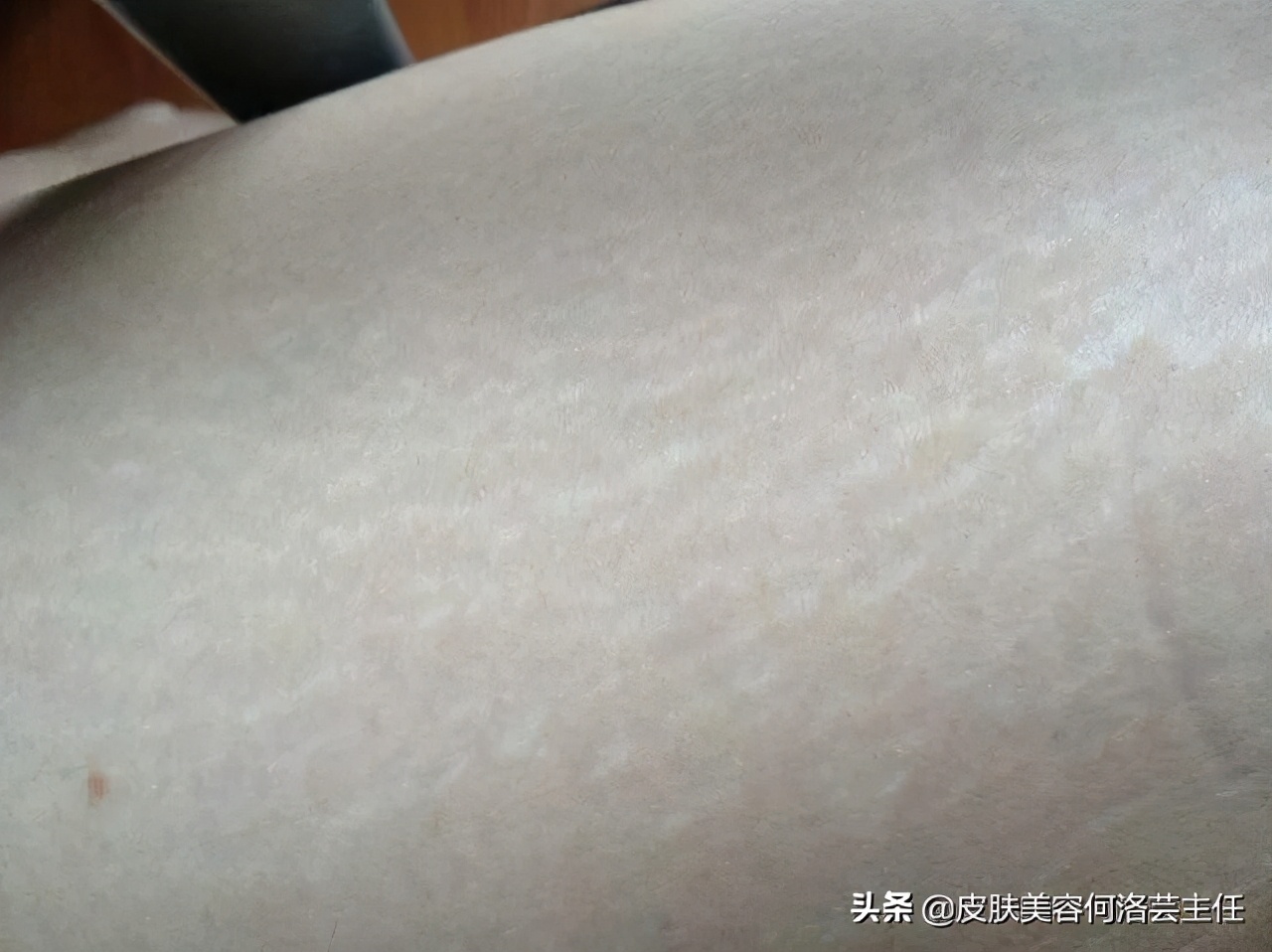 痘痘会家族遗传吗,痘痘会不会遗传下一代