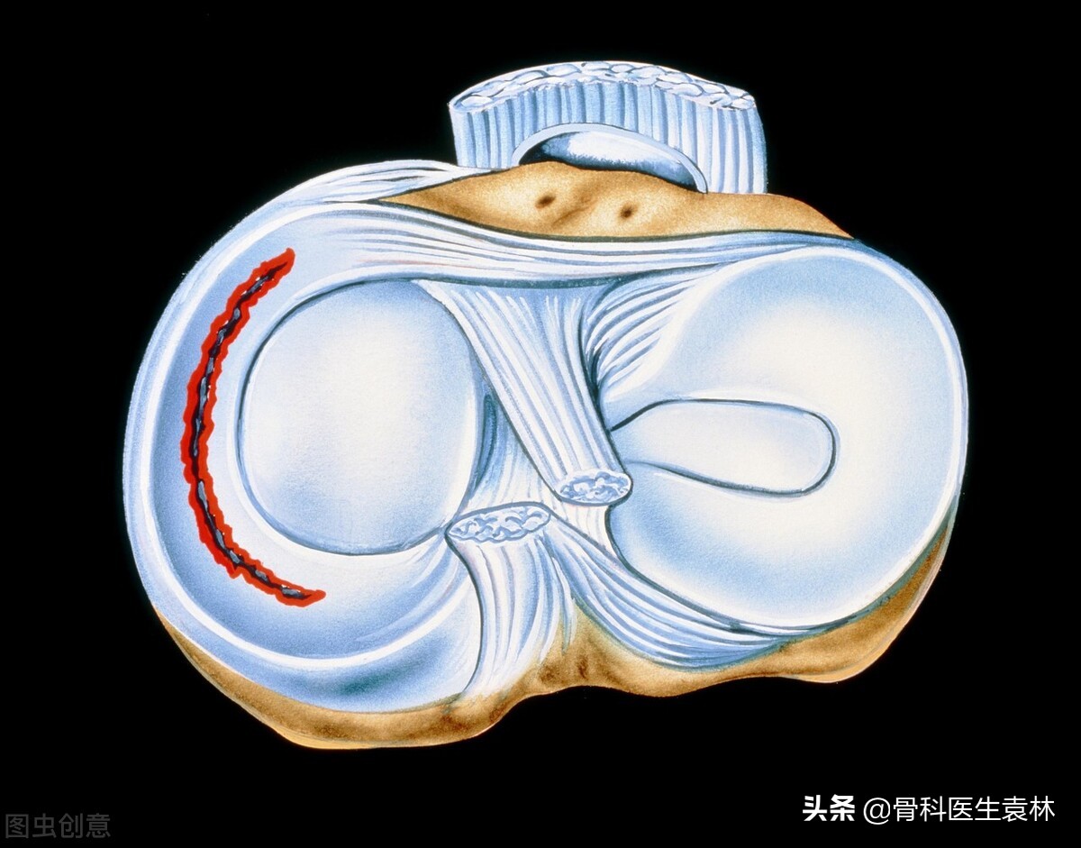 半月板损伤可以治愈吗？半月板损伤的最好治疗方法有哪些？