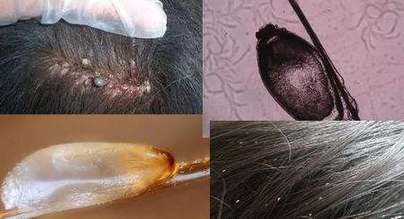 头上有虱子卵的虱子怎么彻底清除,头上长虱子怎么彻底去除更方便