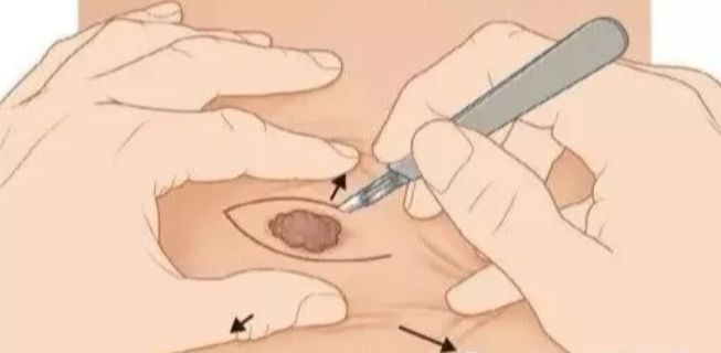 中医点痣治疗法,神奇中医点痣