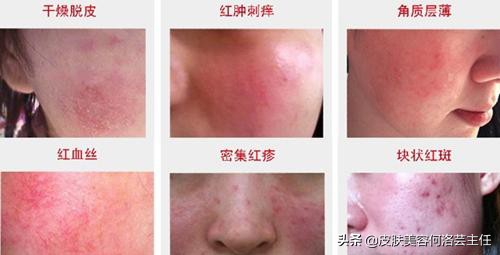 皮肤屏障受损多擦水乳可以恢复吗,脸部皮肤屏障严重受损用什么面霜