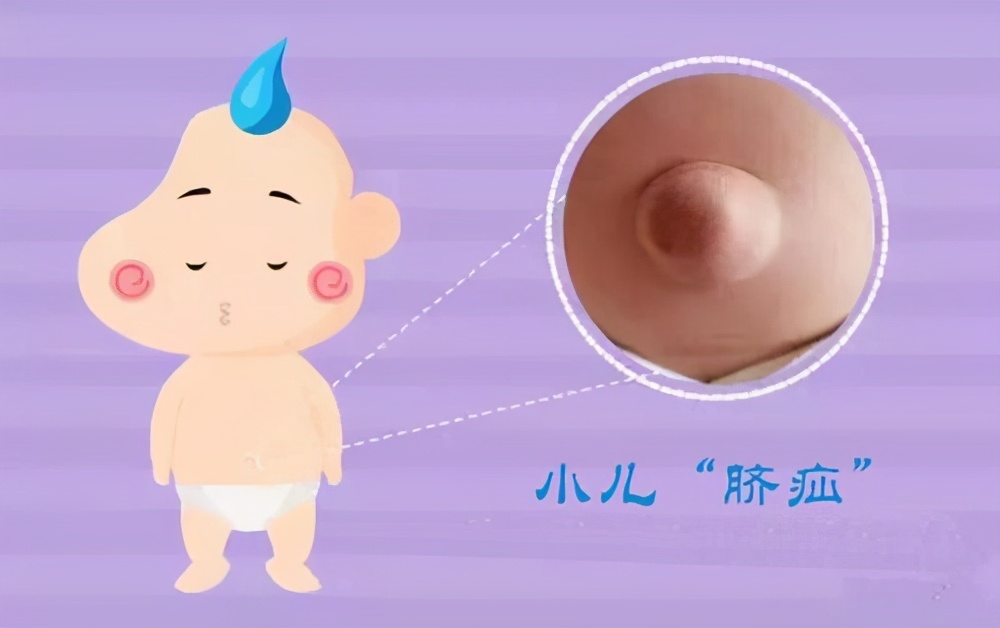 脐疝如何治疗效果好,脐疝怎么治疗最快最好的方法