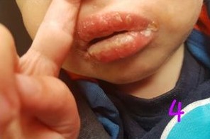 国外宝宝被邻居亲吻后中毒,婴儿被亲嘴感染什么症状