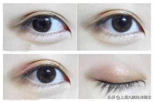 修复双眼皮眼角有分叉怎么办,双眼皮修复折痕分叉