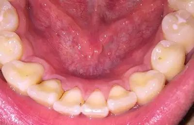 牙上有黑黑的东西，又丑又臭，给你2个解决方法