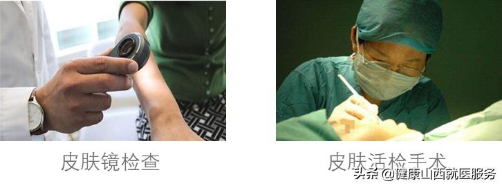 老年斑的形成原因及预防方法,最近老年斑越来越多什么原因