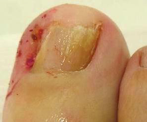 什么原因导致脚趾甲老是嵌甲,脚趾甲老是长到肉里怎么治疗啊