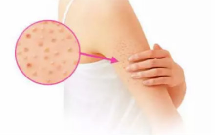 如何摆脱鸡皮肤的恐惧,简单两步轻松搞定鸡皮肤