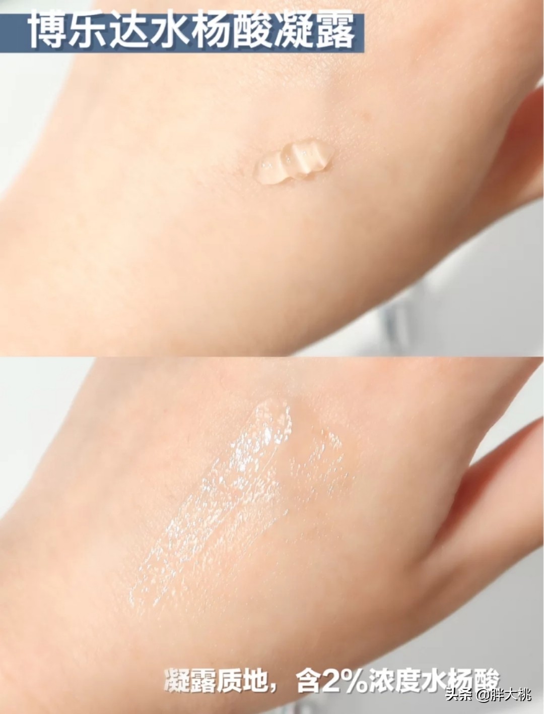 黑头闭口刷水杨酸好还是果酸好,毛孔黑头闭口怎么刷酸
