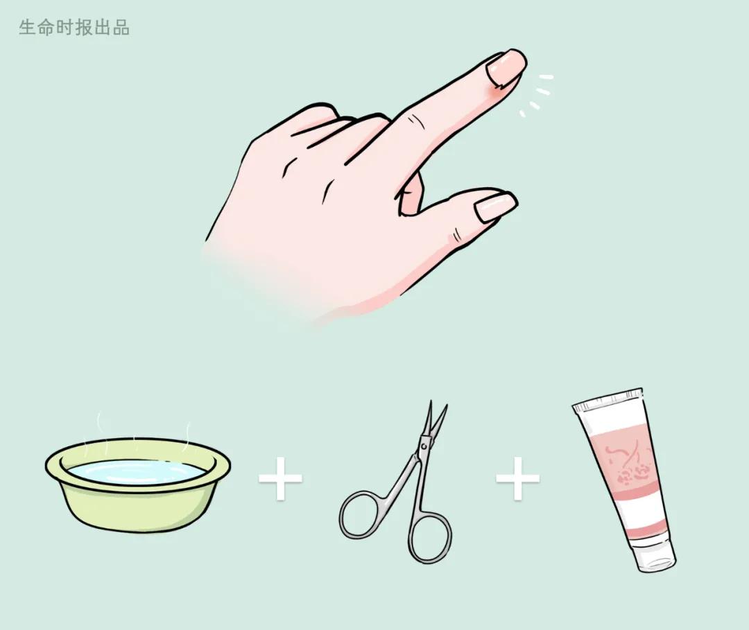 倒刺怎么去除最快方法,长倒刺怎么去除小妙招