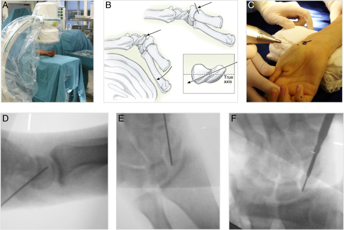 中医治疗腕舟骨骨折,经皮钢板治疗胫骨骨折
