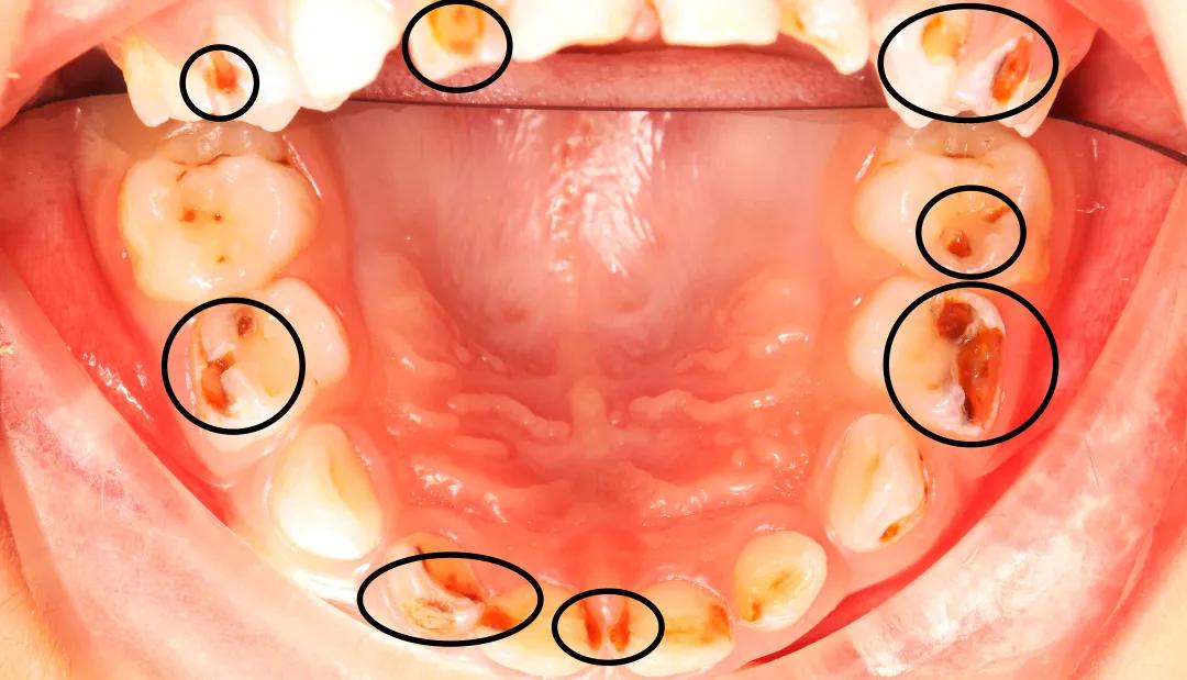 四岁小孩20颗蛀牙视频,4岁孩子蛀牙不痛有必要去补牙吗