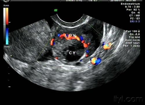 新婚之夜黄体破裂,怀孕的时候黄体破裂是先兆流产吗