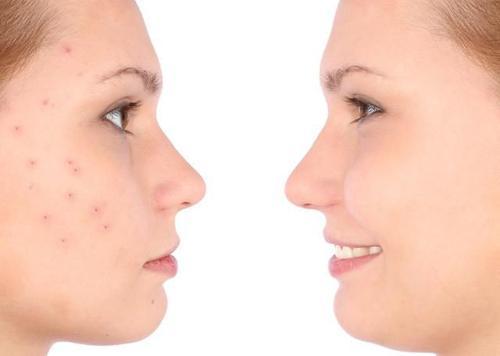 吃什么才能不长痘？这些实用饮食建议，你值得拥有