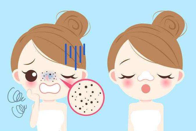 不骗人的去黑头,无声去黑头