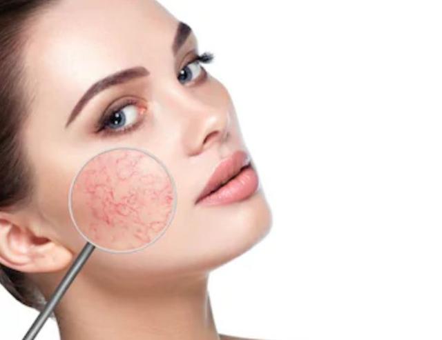 老年人脸上出现细血丝怎么回事,皮肤突然出现一点红血丝怎么回事