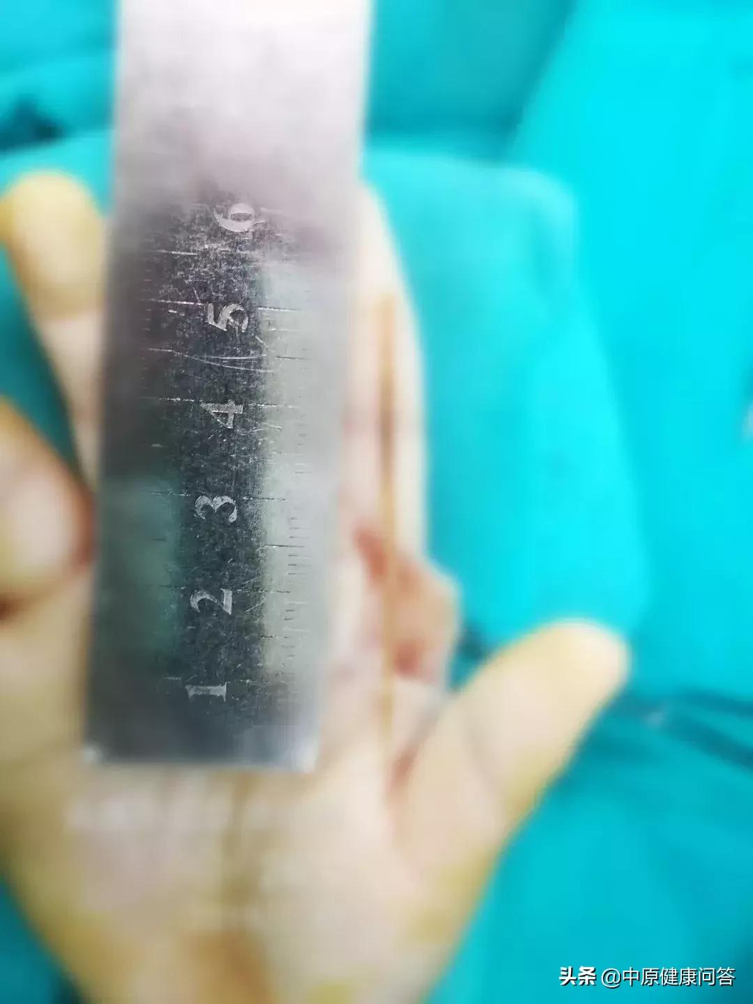 竹签扎到孩子视频,竹签插在小孩嘴里视频