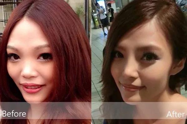 膨体隆鼻跟鼻综合的区别,隆鼻鼻综合做法