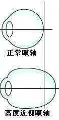 高度近视不适合哪些剧烈运动,高度近视不适合的运动有哪些