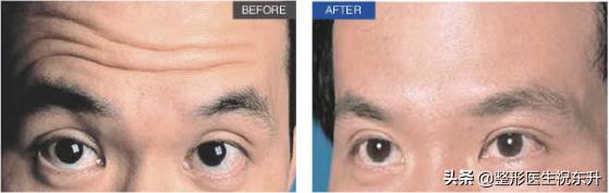 长期打肉毒素肌肉会萎缩么,注射肉毒素是不是康复治疗的方法