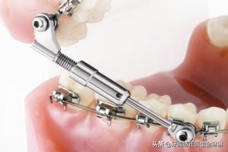 牙齿矫正舍不得给孩子拔牙,矫正牙齿不想戴牙套怎么办