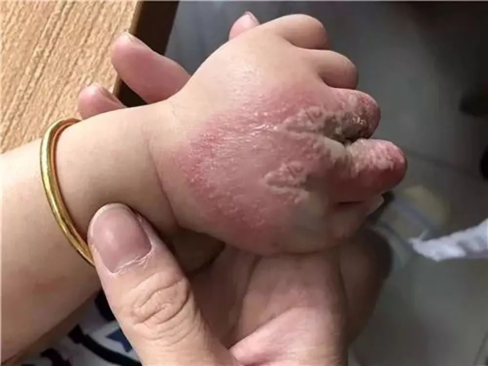 隐翅虫的毒性有多强,隐翅虫黑色的幼虫有毒吗