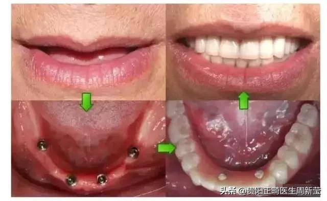 看牙为什么这么贵，牙痛的七个阶段决定你看牙的费用