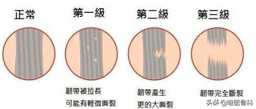 膝关节损伤预防科普视频,膝关节损伤涉及的理论知识