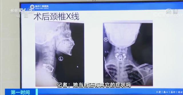 小女孩玩蹦床导致截瘫,最新玩蹦床致截瘫女生身体好转